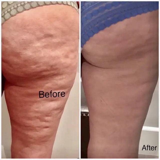 before and after photos for red light and cellulite