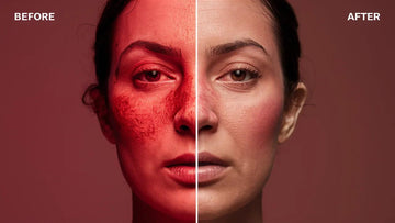 red light therapy rosacea before and after