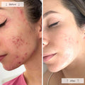 Before and after results using Omnilux Clear red light therapy mask for acne treatment.