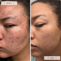 Before and after photos showing acne improvement using Omnilux Clear red light therapy mask.